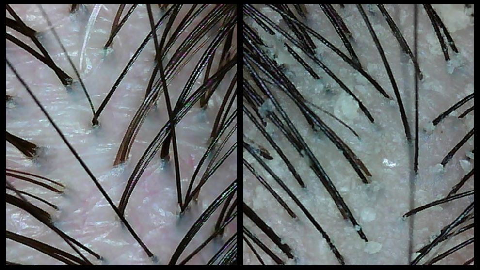 Feature image - How dandruff affects your scalp